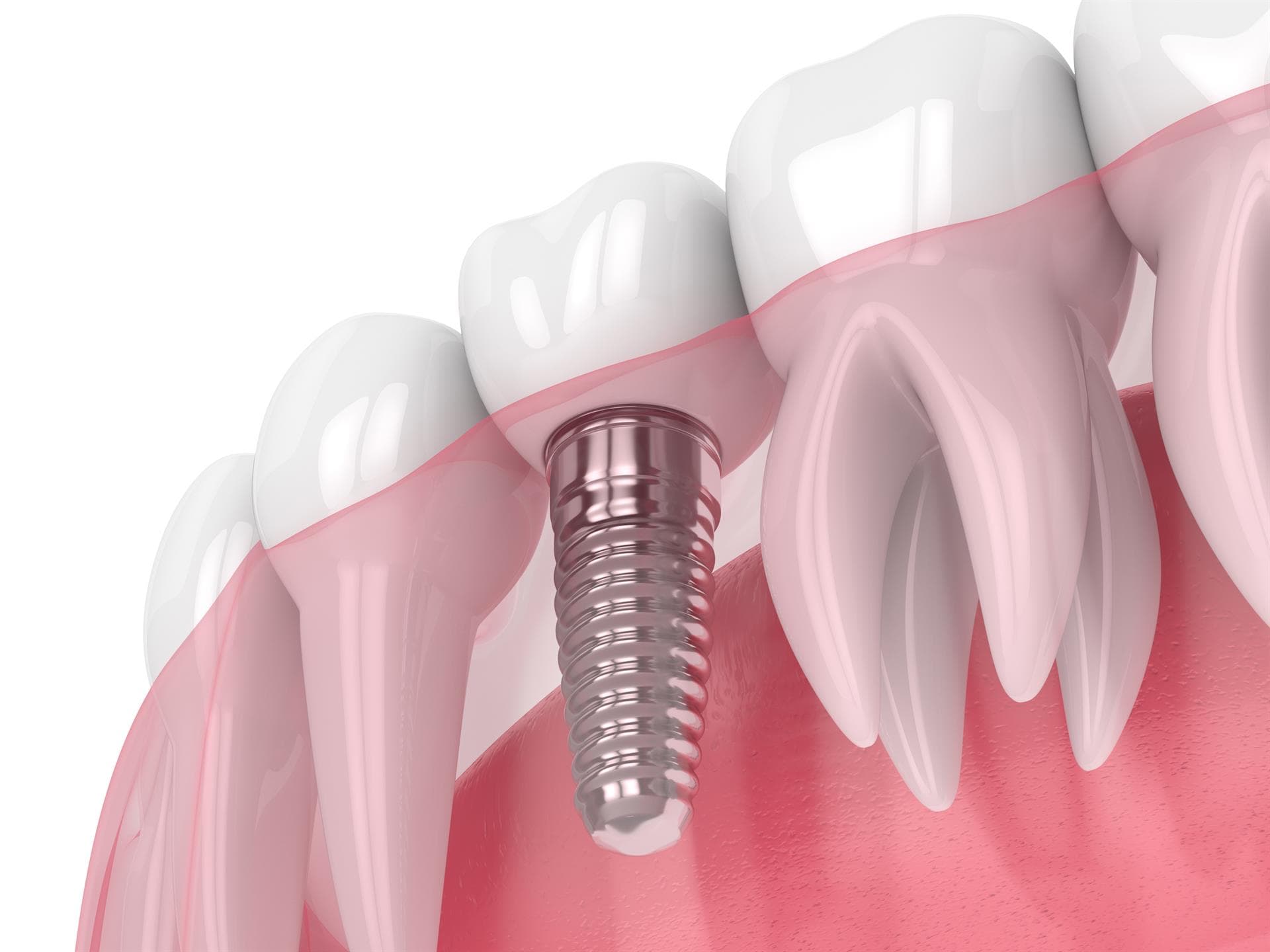  Técnicas en implantología oral