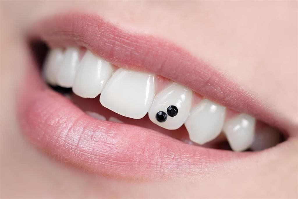 Estética dental: carillas de composite o de cerámica