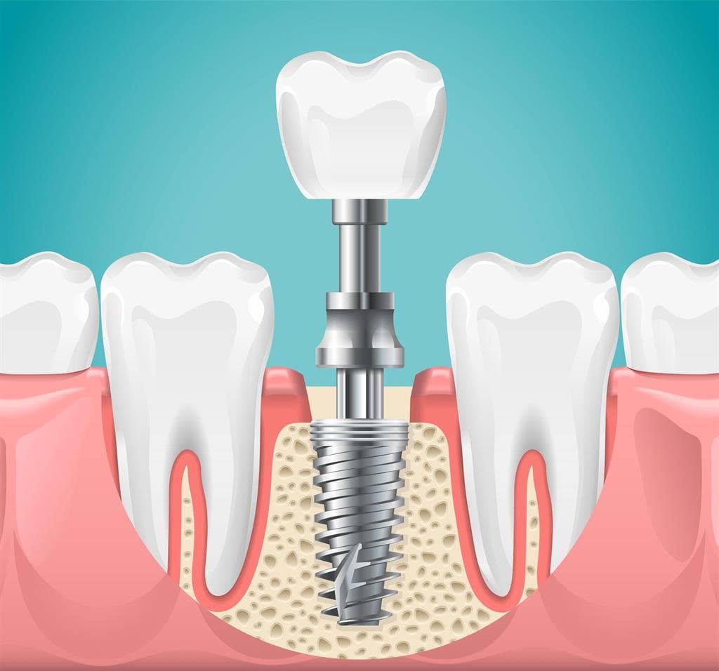  Técnicas en implantología oral
