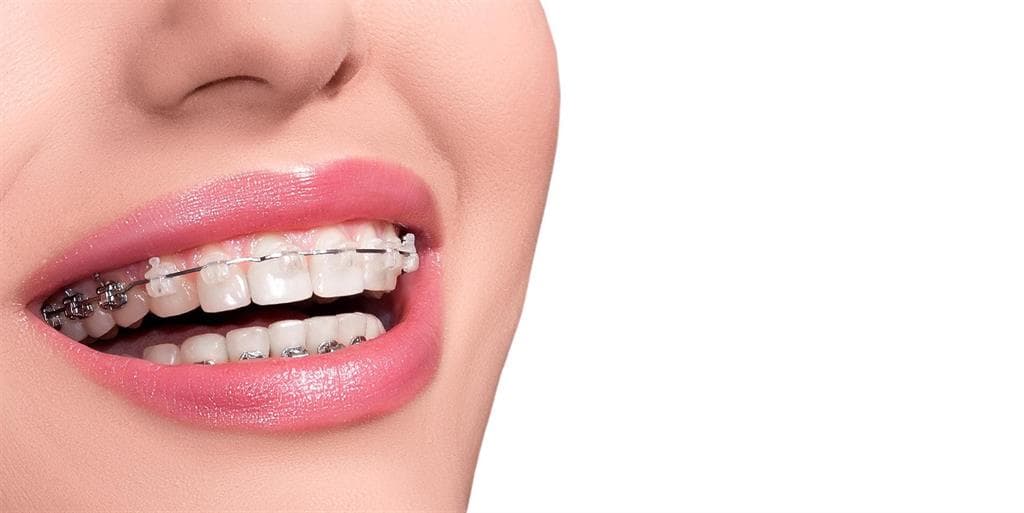  Ortodoncia: Sistema Damon en Ribeira